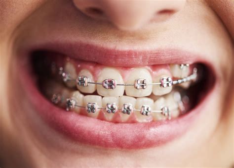 spacers for metal brackets teeth|spacers for teeth before braces.